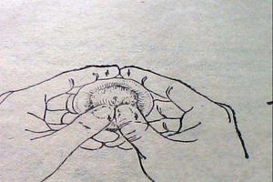 呼和浩特包皮嵌頓護理(呼和浩特包莖手術) 呼和浩特包皮嵌頓護理(呼和浩特包莖手術)