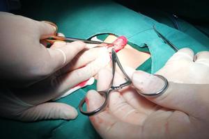 呼和浩特14歲陰莖包皮翻不開(孩子包莖翻不開) 呼和浩特14歲陰莖包皮翻不開(孩子包莖翻不開)