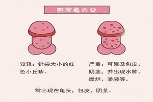 呼和浩特包皮外長個(gè)紅點(diǎn)(包頭有紅點(diǎn)是什么病) 呼和浩特包皮外長個(gè)紅點(diǎn)(包頭有紅點(diǎn)是什么病)