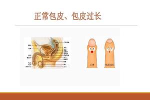 呼和浩特20歲包皮過長(呼和浩特割包皮的手術費多少) 呼和浩特20歲包皮過長(呼和浩特割包皮的手術費多少)
