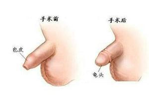 呼和浩特包皮怎么割多少錢啊(成年男性割了皮包要多少錢)