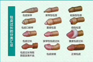 呼和浩特包皮手術會增生嗎(呼和浩特包皮過長不手術怎么治療) 呼和浩特包皮手術會增生嗎(呼和浩特包皮過長不手術怎么治療)