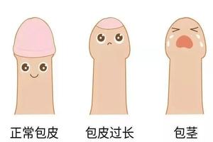 呼和浩特割包皮要準備什么(割了皮包多久可以同房) 呼和浩特割包皮要準備什么(割了皮包多久可以同房)