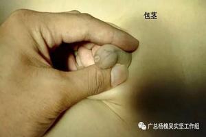 呼和浩特包皮有點長用手翻(呼和浩特包皮包莖的手術費用) 呼和浩特包皮有點長用手翻(呼和浩特包皮包莖的手術費用)