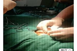 呼和浩特包皮手術怎么康復(割包為什么很多人后悔)