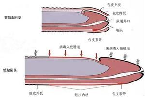 呼和浩特包皮包莖哪個嚴重(呼和浩特哪里割包皮好) 呼和浩特包皮包莖哪個嚴重(呼和浩特哪里割包皮好)