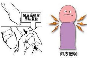 呼和浩特割包皮血腫多久后能消失(割了皮包多久可以痊愈) 呼和浩特割包皮血腫多久后能消失(割了皮包多久可以痊愈)